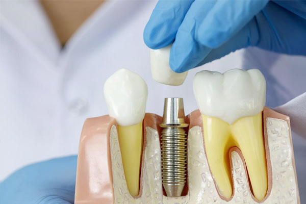 Двухэтапная имплантация зубов
