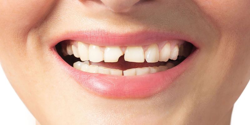 Что делать если зуб откололся или выпал из-за травмы?