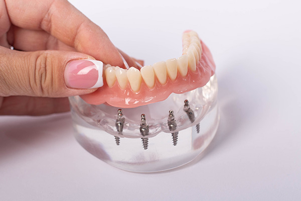 Имплантация зубов все на 4
