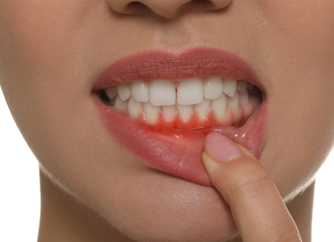 Лечение пародонтита: симптомы