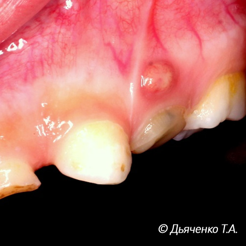 Хронический периодонтит. Свищевой ход.