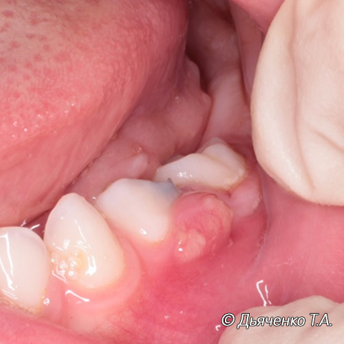 Хронический периодонтит. Свищевой ход.