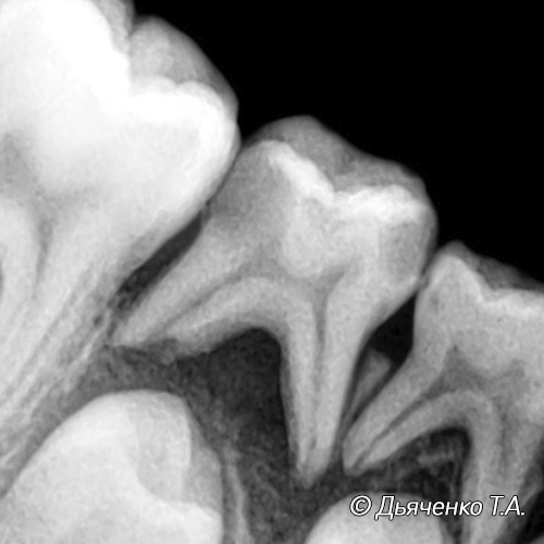 Острый периодонтит молочного зуба