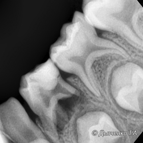 Острый периодонтит у детей