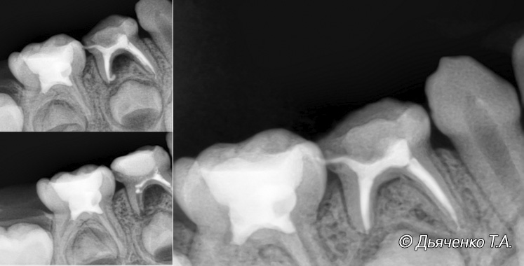 Лечение хронического переодонтита