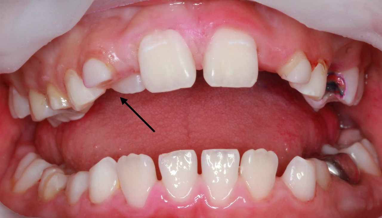 Постоянный зуб, который прорезался за молочным зубом.