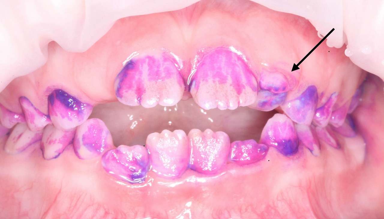 Постоянный зуб, который прорезался над молочным зубом.