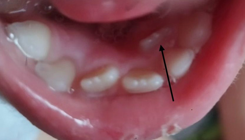 Нижний боковой резец прорезался за молочным боковым резцом.