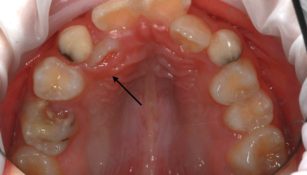 Зуб, который прорезался вторым рядом