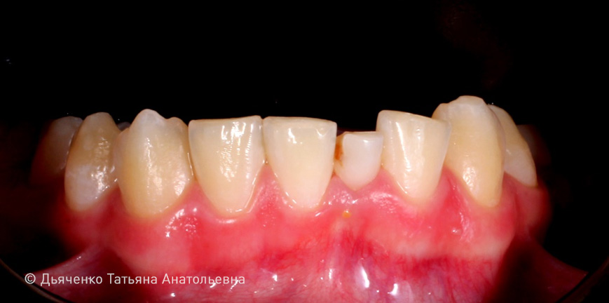 Первичная адентия 31 зуба