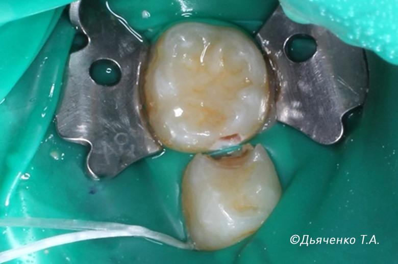 Пульпит 84 молочного зуба: изоляция системой коффердам