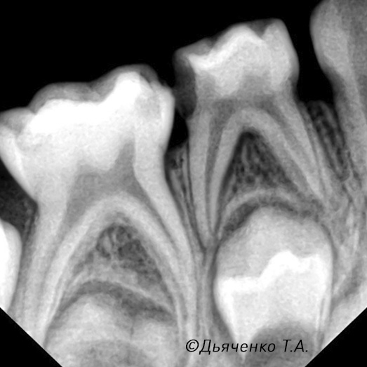 Необратимый пульпит молочного зуба до лечения.