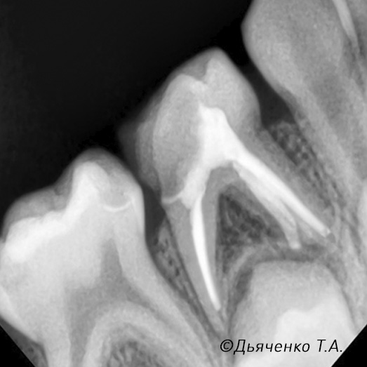 Необратимый пульпит молочного зуба после лечения.