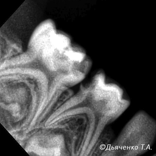 Обратимый пульпит молочного зуба до лечения.