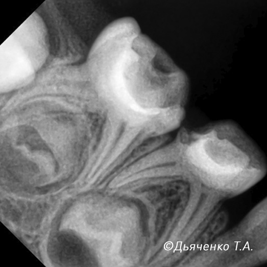 Обратимый пульпит молочного зуба после лечения