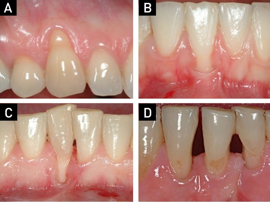 Классификаций десневых рецессий