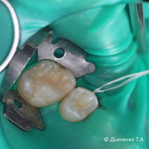 Межзубный, контактный кариес