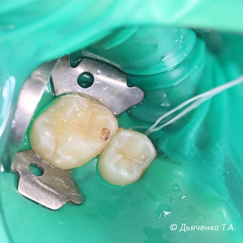 Межзубный, контактный кариес