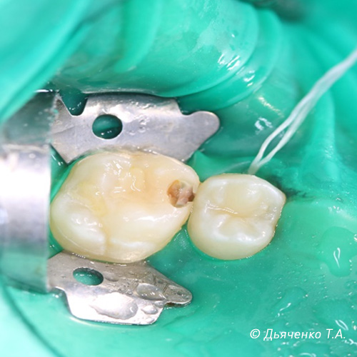 Процесс лечения межзубного, контактного кариеса