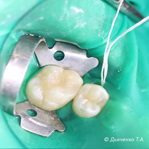 Процесс лечения межзубного, контактного кариеса