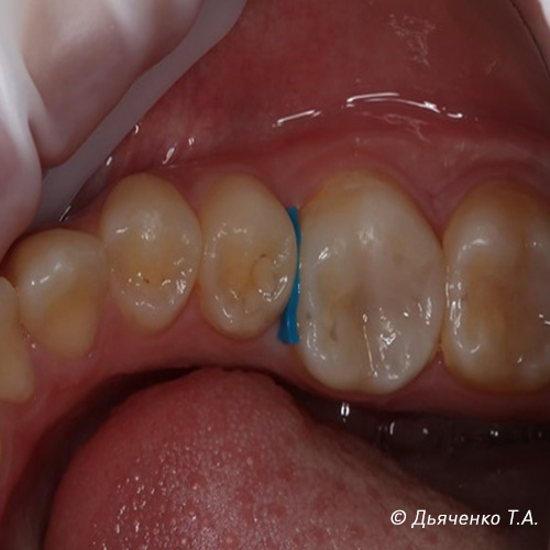 Установка сепарационного кольца