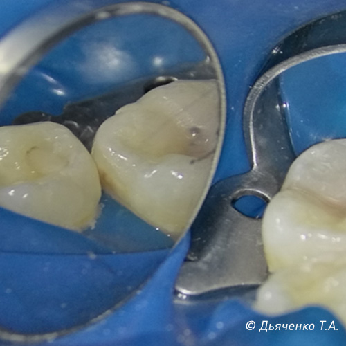 Лечения контактного кариеса в стадии пятна