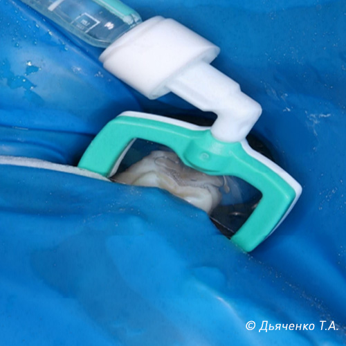 Лечения контактного кариеса в стадии пятна