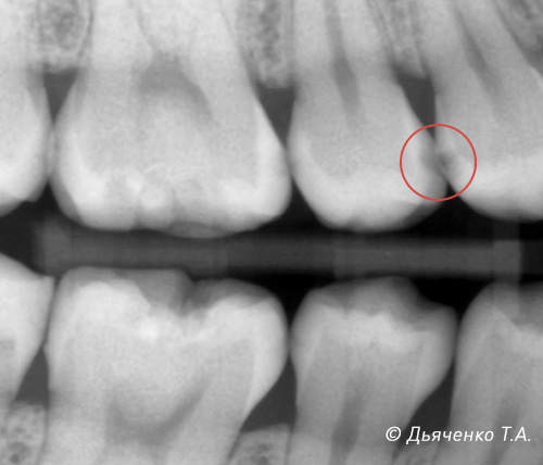 Кариес дентина 14 зуба