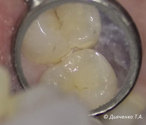 Кариес дентина 14 зуба