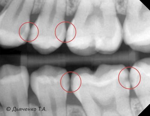 Межзубный, контактный кариес