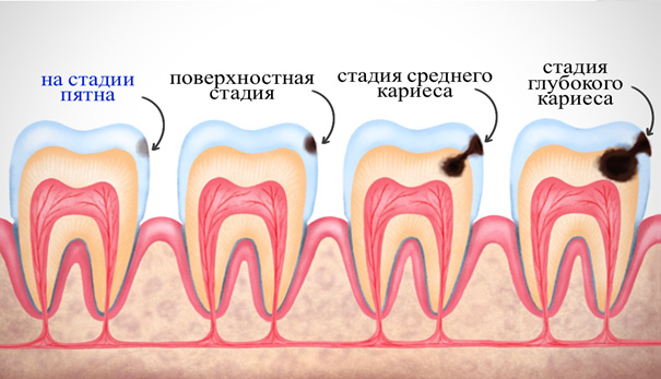 Рентген диагностика контактных пунктов