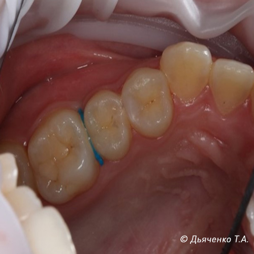 Установка сепарационного кольца