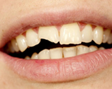 Травма зуба