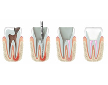 Эндодонтическое лечение зуба